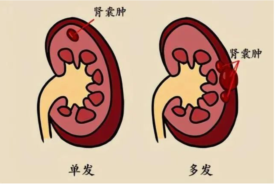 体检查出肾囊肿，危险吗？