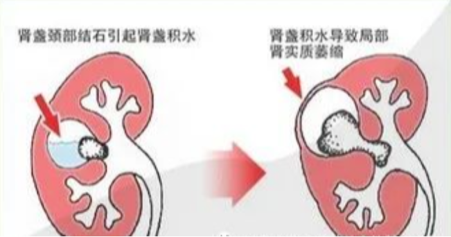 肾积水会影响肾功能吗？
