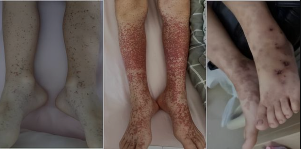 揭秘儿童易发的紫癜性肾炎 揭秘儿童易发的紫癜性肾炎