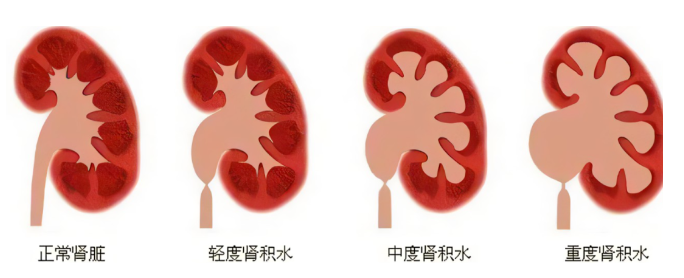 肾积水会影响肾功能吗？