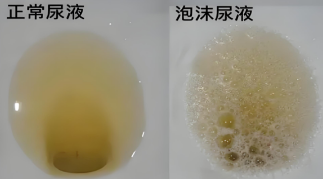 慢性肾炎是什么原因引起的?如何预防? 慢性肾炎是什么原因引起的?如何预防?