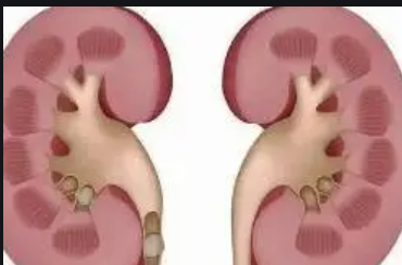 肾结石肾积水要多吃什么水果比较好？这些要记好
