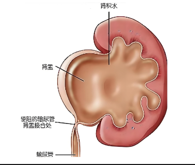 发现肾积水，怎么办？